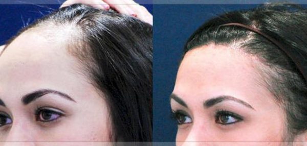العوامل التي تؤثر علي نجاح أو فشل عملية زراعة الشعر