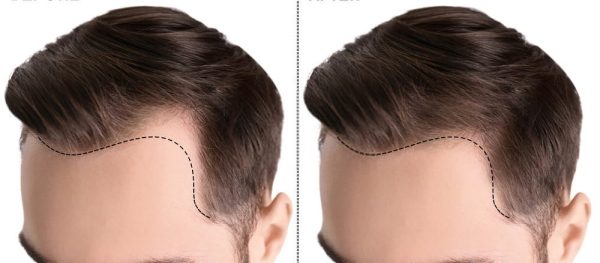 تجربتي في زراعة الشعر في دبي بالتفصيل