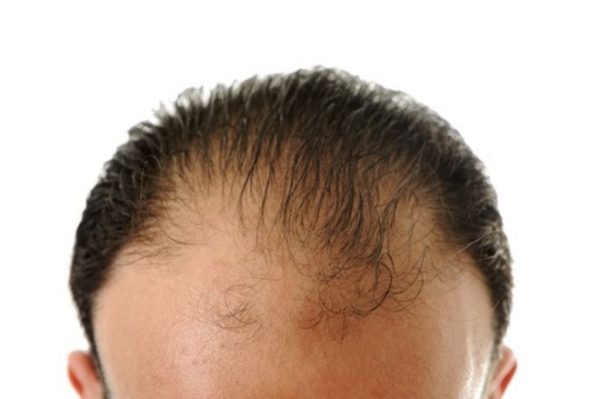 تكاليف زراعة الشعر في دبي