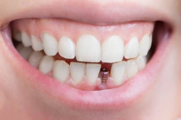 مميزات عملية زراعة الأسنان في الفلبين