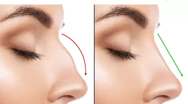 أسعار عمليات التجميل في كوريا الخاصة بتجميل الأنف